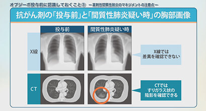 【4】オプジーボ投与前に認識しておくこと(3) (加藤 晃史 先生)